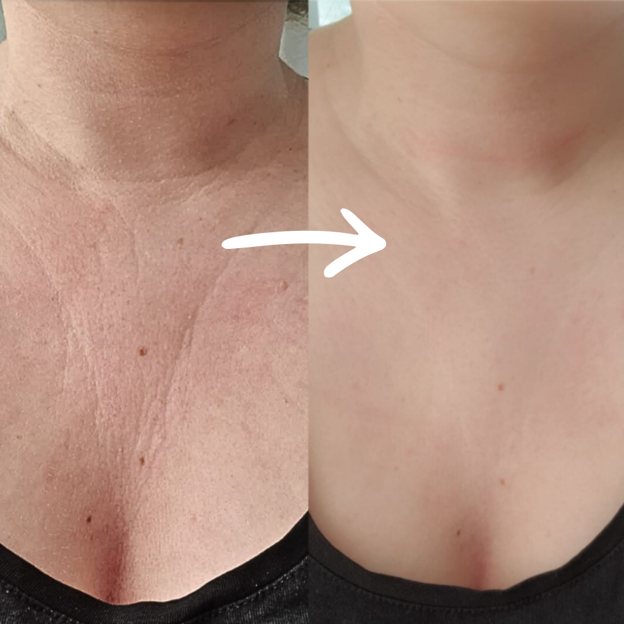 Silkana Dekolleté Patch